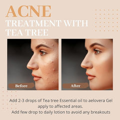 Tea Tree essential oil